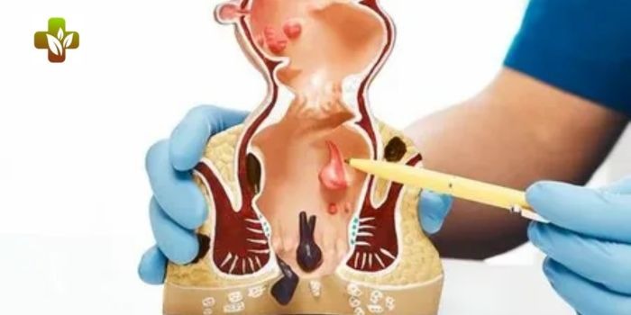 Right-Clinic-for-Fissure-Treatment-in-Delhi-1