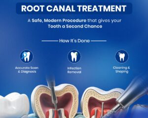 Root-canal-treatment-cost-in-delhi