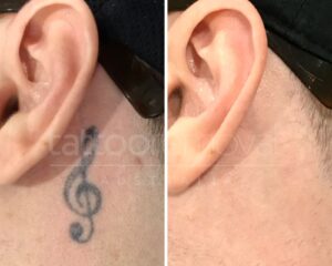 Tatto-removal-australia-before-and-after-results