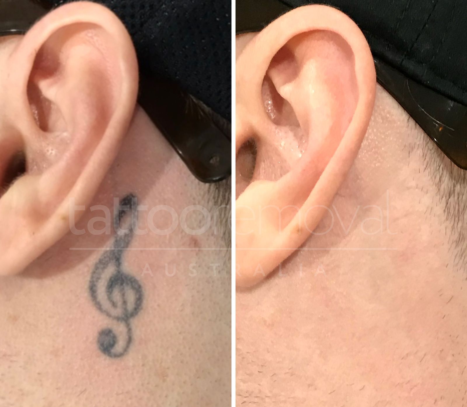 Tatto-removal-australia-before-and-after-results