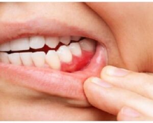how-to-stop-bleeding-from-a-tooth-extraction