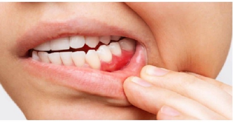 how-to-stop-bleeding-from-a-tooth-extraction