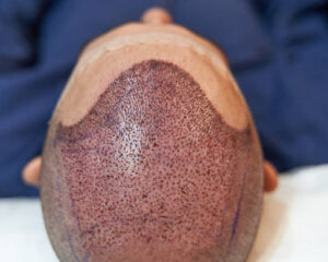 Hair-Transplant-Cost-in-Saudi-Arabia-2026-18