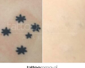 6a2aa25ebf49b6b7295258db_Before-and-after-skin-results