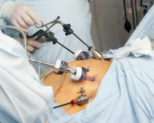 Fibroid-Ablation