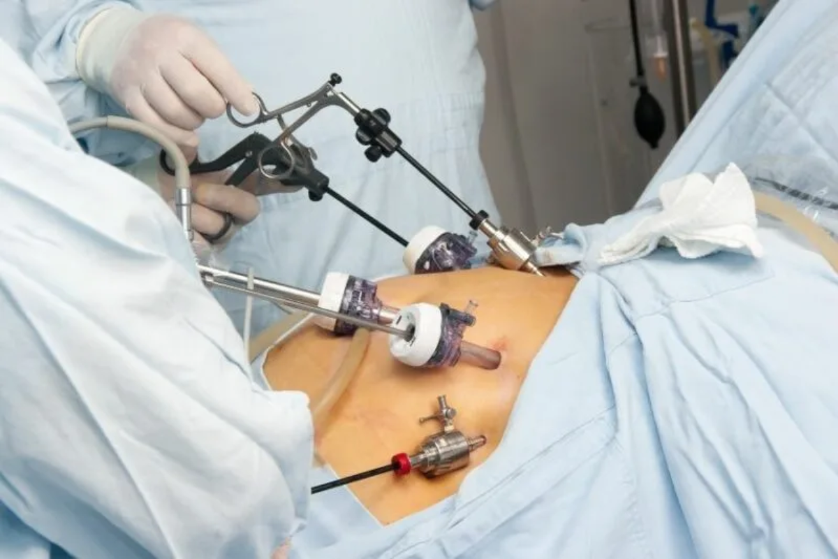 Fibroid-Ablation