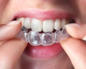 Invisible-Braces-Treatment-In-Noida