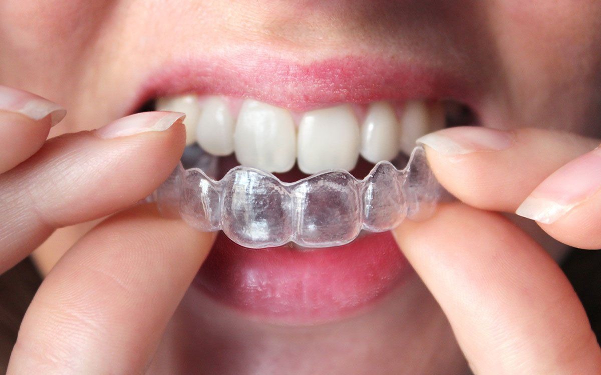 Invisible-Braces-Treatment-In-Noida