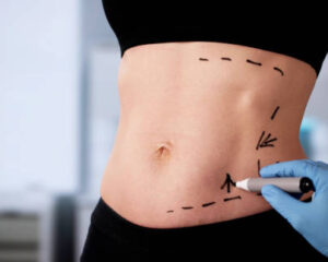 Liposuction-in-Riyadh-5-1