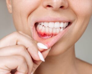 Periodontal-Disease