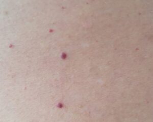 cherry-angioma-treatment