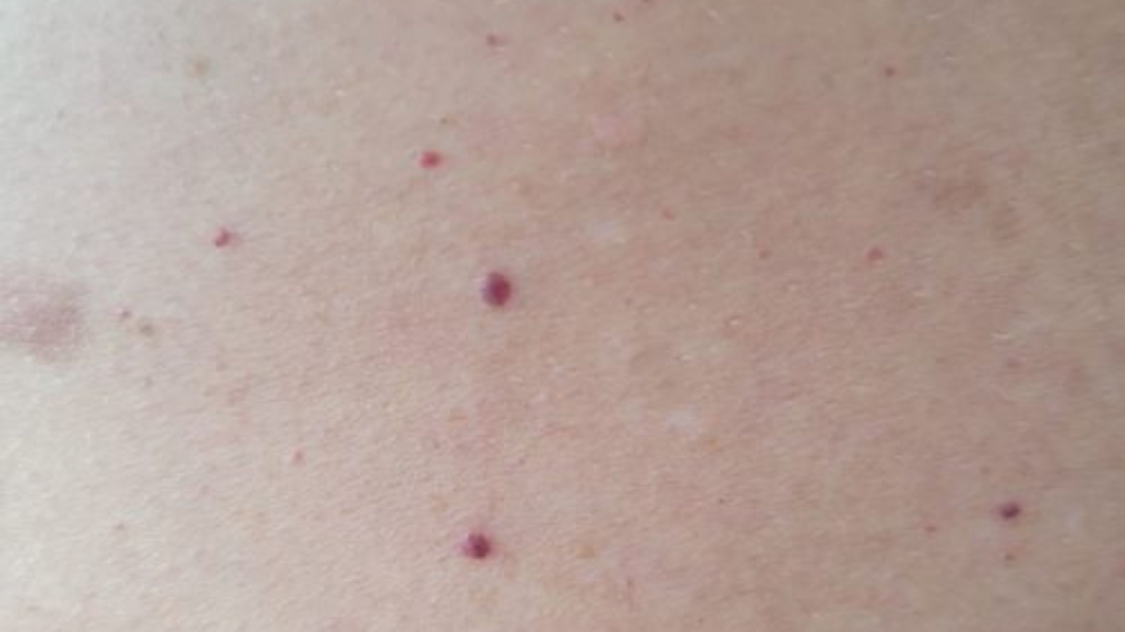 cherry-angioma-treatment