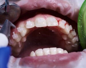 how-to-remove-plaque-from-teeth