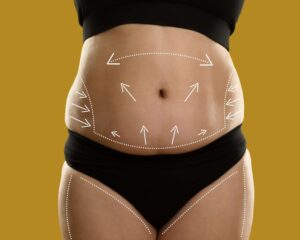 liposuction-riyadh-KSa